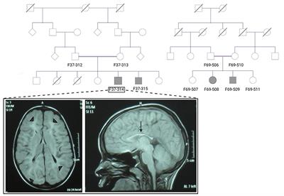 Pathogenic Variants in ABHD16A Cause a Novel Psychomotor Developmental Disorder With Spastic Paraplegia